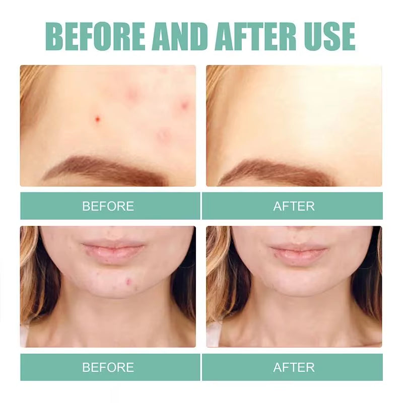 Acne Mask Patch Facial Treatment Desalinate Pimple Marks Pimple Patch Mild and Non-Irritating Healing Acne Acne Repair Patch