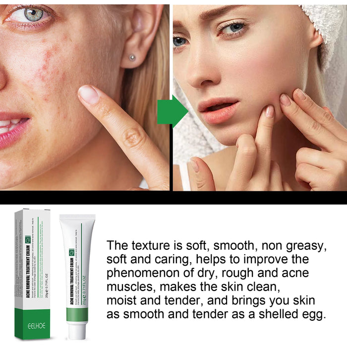 EELHOE Acne & Blemish Cream