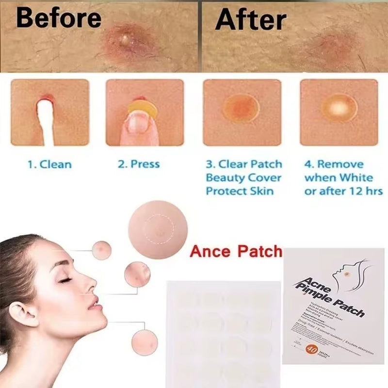 24Pcs Face Acne Pimple Spot Facial Skin Care Blackhead Removal Freckle Patches Scar Care Treatment Stickers Acne Mask Beauty