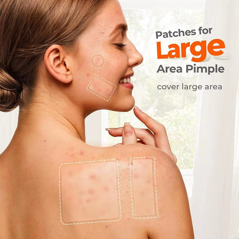 Mixed Sizes Hydrocolloid Pimple Patches Large Hydrocolloid Pimple Patches Invisible Acne Circle Stickers for Zits, Spots, Pimple