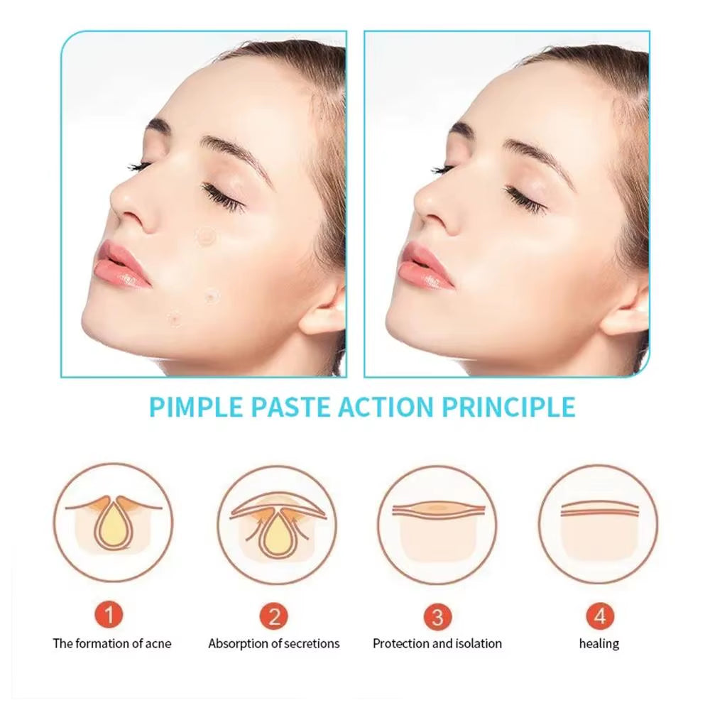 30/150Pcs Acne Pimple Patches Invisible Hydrocolloid Essential Oil Acne Treatment Salicylic Acid Tea Tree Essential Oil for Acne