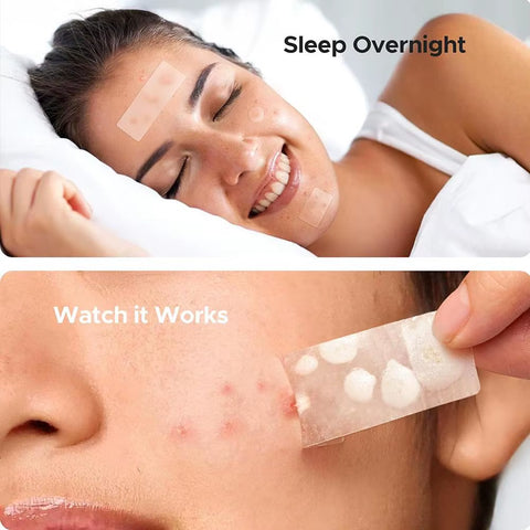 Mixed Sizes Hydrocolloid Pimple Patches Large Hydrocolloid Pimple Patches Invisible Acne Circle Stickers for Zits, Spots, Pimple
