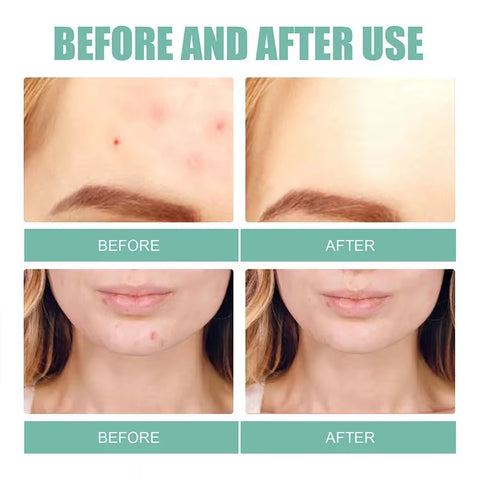 Acne Mask Patch Facial Treatment Desalinate Pimple Marks Pimple Patch Mild and Non-Irritating Healing Acne Acne Repair Patch