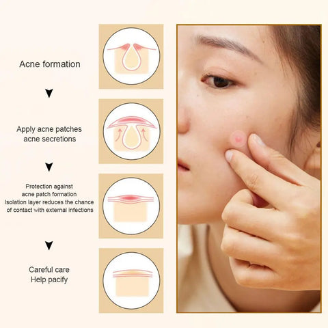 35/40Pcs Colorful Cute Star Heart Shaped Acne Treatment Sticker Invisible Acne Cover Pimple Patch Skin Care